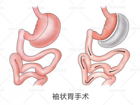 吴良平:胃旁路手术与袖状胃切除术的优缺点对