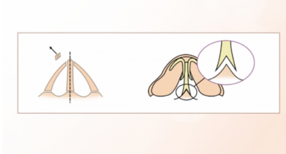 燕尾榫自体软骨隆鼻技术原理