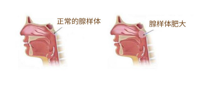 保定民众耳鼻喉:腺样体肥大为什么医生都建议手术