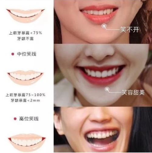 笑容曲线 这个定义是指,上排牙齿的边缘所形成的弧度与下唇的曲线